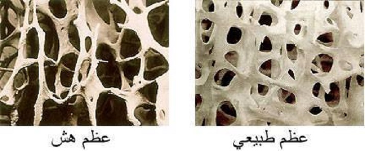   Osteoporosis